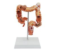 Modèle de Lésion du Côlon Humain Modèle Pathologique du Côlon Modèle d'anatomie des Organes Modèle de SystèMe Digestif Humain pour Outils de Démonstration en Classe