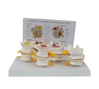 Modèle de Lésion du Rachis Lombaire Détachable, Modèle de Comparaison de la Colonne Lombaire en 4 Étapes avec Carte d'Instruction en Anglais pour Outils Pédagogiques