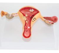 Modèle De Lésion Utérine - Organes Internes Et Externes Féminins Modèle Anatomique - PVC Anatomie Humaine Sciee Models - pour La Gynécologie Aide à La Formation Modèle De Formation Médicale