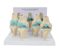 Modèle de maladie articulaire en 4 étapes PVC Lésion Life Lésion Modèle Articulation du Genou Osteoarthrite Modèle Anatomique avec Carte arrière et Base d'affichage pour l'étude