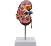 Modèle de Maladies rénales, Rein Normal et Malade | Modèle de rein normal et malade avec infection, for l'enseignement et la démonstration
