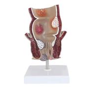 Modèle De Pathologie Ano-rectale Humaine À Usage Éducatif | Modèle anatomique réaliste for enseigner efficacement les maladies rectales.