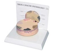 Modèle de pathologie du cancer de la peau - Outil pédagogique d'anatomie cutanée humaine agrandie for la dermatologie et l'enseignement médical - Démonstration de la règle ABCDE