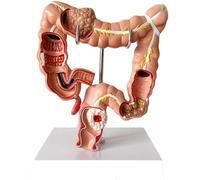 Modèle de pathologie du côlon, modèle d'anatomie gros intestin humain - lésion viscérale en PVC, anatomie humaine, système digestif, d'apprentissage et d'enseignement