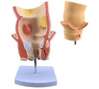 Modèle de pathologie rectale humaine, enseignement de l'anatomie des lésio | Simule les conditions pathologiques des hémorroïdes, des fistules et des fissures, modèle de démonstration