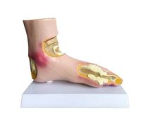 Modèle de pied d'arthrite pour la formation médicale et la démonstration en salle de classe - Outil éducatif de pathologie du pied pour les cabinets médicaux