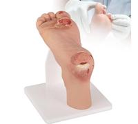 Modèle de Pied Diabétique, Échelle 1:1 Contraste Pathologique Léger et Sévère, Anatomie du Pied pour Formation Infirmière et Podologie, Simulation de Classification des Ulcères,Mild