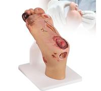 Modèle de Pied Diabétique, Échelle 1:1 Contraste Pathologique Léger et Sévère, Anatomie du Pied pour Formation Infirmière et Podologie, Simulation de Classification des Ulcères,Severe