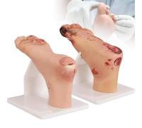 Modèle de Pied Diabétique, Échelle 1:1 Contraste Pathologique Léger et Sévère, Anatomie du Pied pour Formation Infirmière et Podologie, Simulation de Classification des Ulcères,OneSet