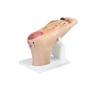 Modèle De Pied Diabétique for La Formation En Soins Infirmiers | Simulateur d'anatomie grandeur nature 1:1 avec lésions purulentes, nécrose et base d'affichage en acrylique(Severe)