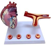 Modèle de pontage coronarien - Anatomie pédagogique des obstructions et thromboses vasculaires for les études en cardiologie