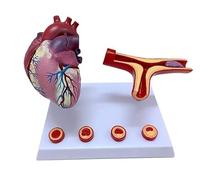 Modèle de pontage coronarien, modèle de thrombose par blocage des vaisseaux sanguins, modèle de cœur humain, modèles d'enseignement, modèles scientifiques for la t l'étude de cardiologie