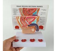 Modèle de prostate 3D Modèle de vessie abdominale et de prostate masculin humain Modèle d'explication médecin-patient en bonne santé et malade, for l'hôpital et l'affichage de formation