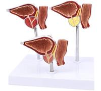 Modèle de prostate grandeur nature - Comparaison modèles normale et malade Modèles d'enseignement médical for la recherche l'exposition
