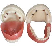 Modèle de prothèse dentaire détachable, modèle d'implants dentaires, prothèse buccale complète, modèle de dents de démonstration for adultes for l'enseignement scolaire, les études.