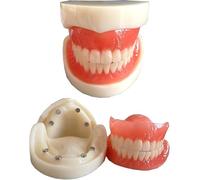 Modèle De Prothèse Dentaire - Modèle D’étude Prothèse Complète Adsorption Magnétique Modèle De Dents - Modèle éducatif De Dents Dentaires - pour L’éducation des Patients