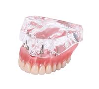 Modèle de prothèse dentaire, modèle de démonstration dentaire des dents, modèle d'implant dentaire de restauration de prothèse dentaire avec implants supérieurs