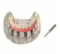 Modèle de Restauration d'implant Dentaire Modèle de mâchoire édentée pour l'éducation et Les démonstrations dentaires