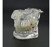 Modèle de simulation d'implant de typopas dentaire pour la restauration des implants dentaires, pathologie pédagogique, démonstration (transparent clair)