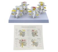Modèle de squelette, modèle d ' anatomie des vertèbres lombaires, lésions en 4 étapes, aide pédagogique comparative, squelette humain