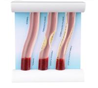 Modèle de Vaisseau sanguin Humain en 3D avec caractéristiques pathologiques, comparaison des obstructions, Moule d'affichage des plaques lipidiques pour l'éducation et la Recherche médicales