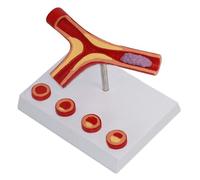 Modèle De Vaisseau Sanguin Humain Modèle Anatomique Vasculaire Modèle De Vaisseau Sanguin Pathologique Modèle D'artérioschlérose Et De Thrombose Anatomique Vasculaire Enseignement