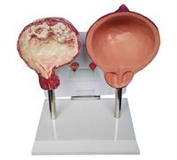 Modèle de vessie médicale pour l'enseignement - Tabagisme comparé et vessie | Modèle d'enseignement de l'anatomie de la vessie - Comparez les conditions saines et anormales pour l'éducation médicale