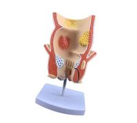 Modèle d'enseignement de l'anatomie pathologique, pathologie rectale