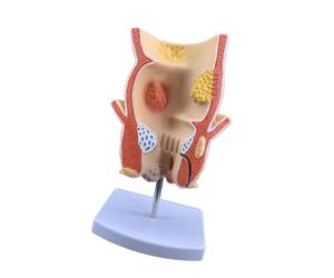 Modèle d'enseignement de l'anatomie pathologique, pathologie rectale