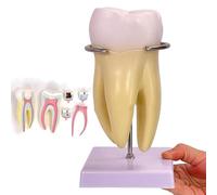 Modèle D'enseignement Dentaire à Grossissement 3X, Modèle D'anatomie Des Dents de Carie Humaine, Nerf Dentaire Détachable 6 Parties, Matériau PVC, pour Affichage, Enseignement