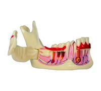 Modèle dentaire anatomique Décomposition mandibulaire Caries buccales et kystes radiculaires Outil de démonstration pour dentistes et éducateurs