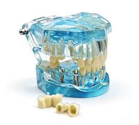 Modèle dentaire de réparation neurale, modèle pédagogique de dents amovibles pour l'enseignement de l'anatomie et de la pathologie en école dentaire, outil pédagogique de démonstration(blue)