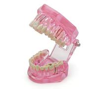Modèle dentaire de réparation neurale, modèle pédagogique de dents amovibles pour l'enseignement de l'anatomie et de la pathologie en école dentaire, outil pédagogique de démonstration(pink)