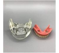 Modèle Dentaire - Implant Dentaire - Prothèse Supra-mandibulaire Inférieure 2 Implants Démo pour l'enseignement Et L'étude