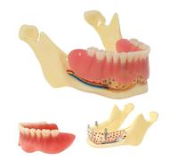 Modèle dentaire oral, modèle de couverture de prothèse mandibulaire, modèle d'affichage d'implant avec prothèse amovible au niveau du nerf, for la recherche, l'enseignement et les études