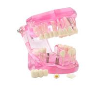 Modèle dentaire transparent pour maladie, modèle d'analyse des dents lmplantes, démonstration de modèle de dents standard, modèle de dent, avec pont couronne amovible pour l'éducation des étudiants