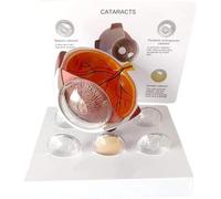 Modèle détaillé de Globe oculaire Humain avec cornée et Structure de la cataracte, Support Anatomique pour la t l'éducation médicale