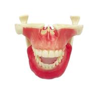 Modèle d'étude for implants maxillaires - Outil pédagogique for la formation à la technique de comblement sinusien et à la pose de clous d'ancrage