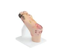 Modèle diabétique de pied, simulateur diabétique de pied avec 1-3 doux ou 4-5 lésions graves, modèle purulent d'anatomie de blessure pour la formation et la démonstration de soin de blessure