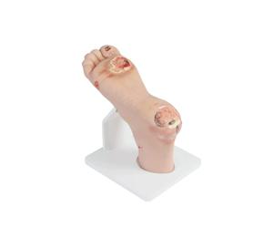 Modèle diabétique de pied, simulateur diabétique de pied avec 1-3 doux ou 4-5 lésions graves, modèle purulent d'anatomie de blessure pour la formation et la démonstration de soin de blessure