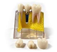 Modèle d'implant dentaire à 4 implants avec bridge et couronne amovibles, racines dentaires amovibles, pour l'éducation, la communication avec les patients, l'apprentissage et le laboratoire.
