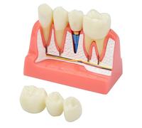 Modèle d'implant dentaire amovible avec pont couronne 4 fois pour étude, démonstration pédagogique et éducation des patients