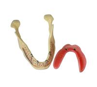 Modèle Dimplant Dentaire Amovible - Typodonte De La Mâchoire Inférieure avec Prothèse Complète All-on-4 Et 4 Implants, Idéal pour La Formation Et La Démonstration Dentaires.