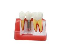 Modèle d'implant dentaire - Couronne amovible - 4 dents - Modèle de démonstration pour l'enseignement, la démonstration, l'éducation des patients et l'apprentissage des étudiants