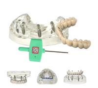 Modèle d'implant dentaire, implant tout sur 4 modèles de traitement de surprothèse dentaire, mâchoire supérieure 4 implants, pont avec titane, base transparente (tous sur 4 modèles de pont en titane