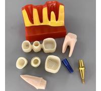 Modèle D'implant Dentaire - Modèle De Dent De Démonstration Pour Couronne Bridge Amovibles (4 Fois) - Modèle De Dent Pour L'analyse D'implants Dentaires À Des Fins D'apprentissage De Formation