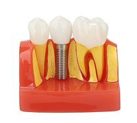 Modèle D'implant Dentaire pour L'éducation des Patients, Modèle D'implant Dentaire, Modèle de Couronne et de Pont pour L'éducation, Communication avec les Patients, Laboratoire