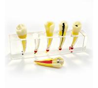 Modèle d'implant dentaire pour l'éducation du patient, modèle de traitement endodontique/démonstration d'anatomie canalaire, modèles de dents pédagogiques pour la démonstration