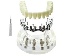 Modèle d'implant dentaire, prothèse amovible mandibulaire sur implants, avec 6 implants, démonstration des dents, modèle transparent à visée pédagogique et d'étude