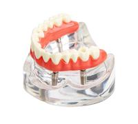 Modèle d'implant dentaire, prothèse, dents de la mâchoire supérieure, vis amovibles, modèle Typodont for décoration éducative (4 implants livrés avec un tournevis)